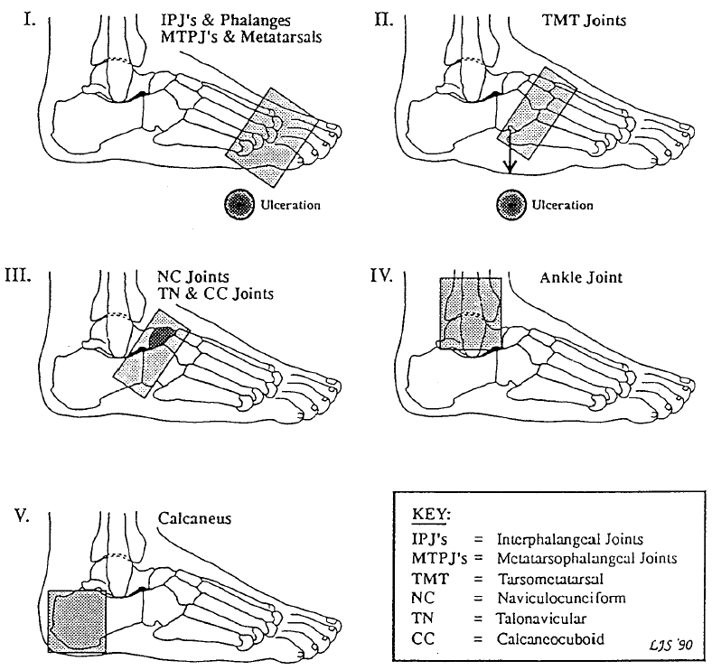 Charcot joints location chart